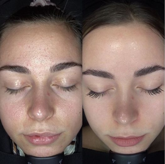 Soins IPL Laser — photo 8