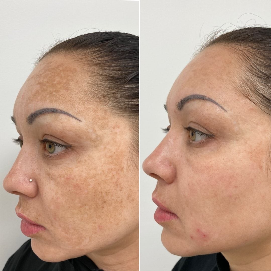 Soins IPL Laser — photo 10