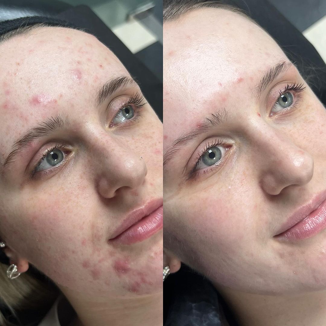 Soins IPL Laser — photo 11
