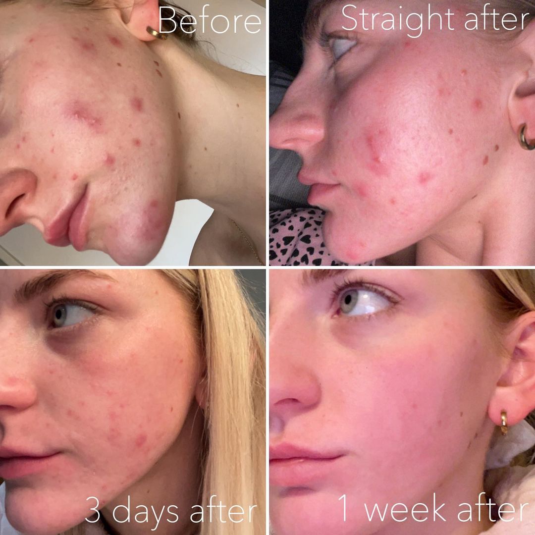 Soins IPL Laser — photo 12
