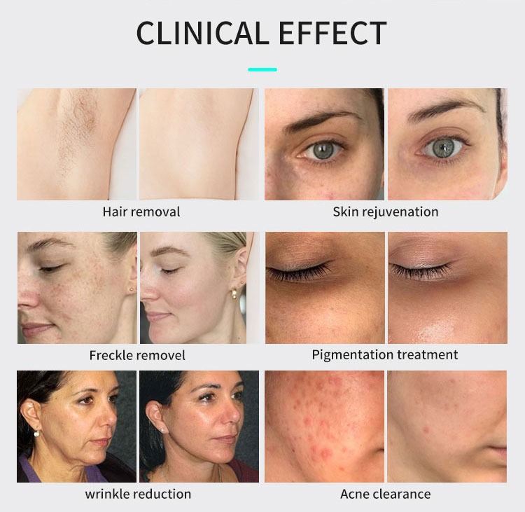 Soins IPL Laser — photo 13