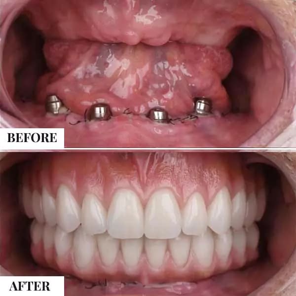 Dental Implant Case