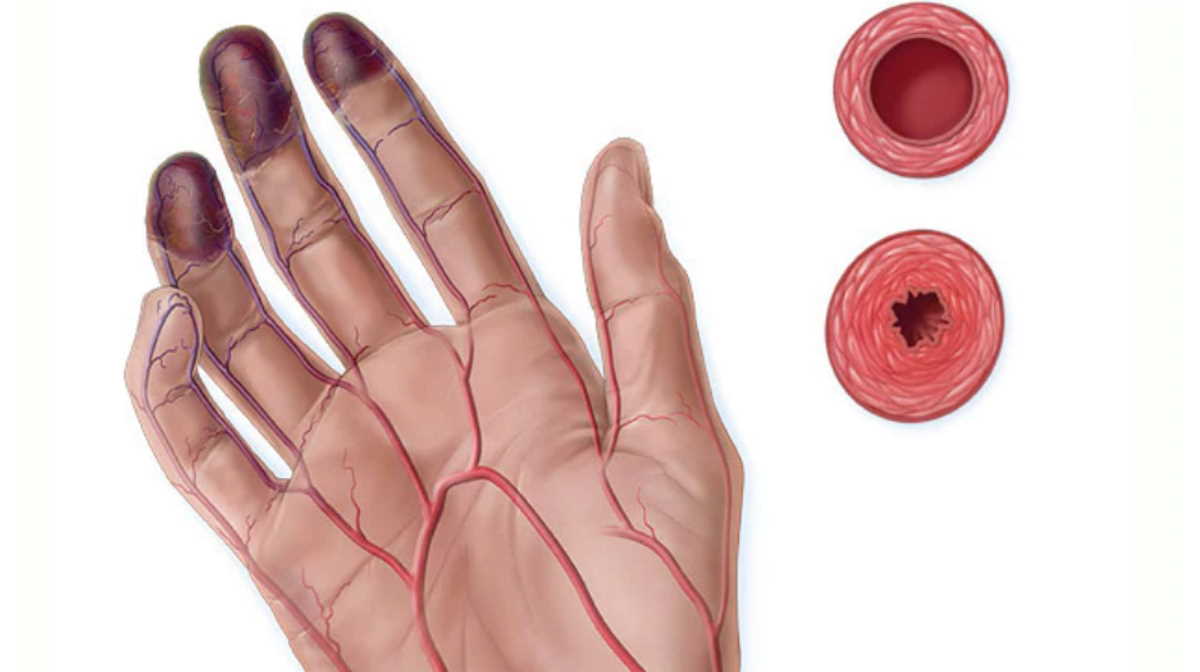 Buerger's disease, a 'young' disease for older people, a 'smoking