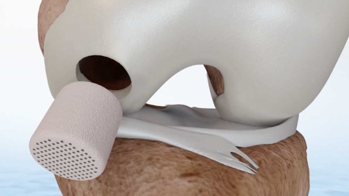 Smith+Nephew acquires novel cartilage regeneration technology for