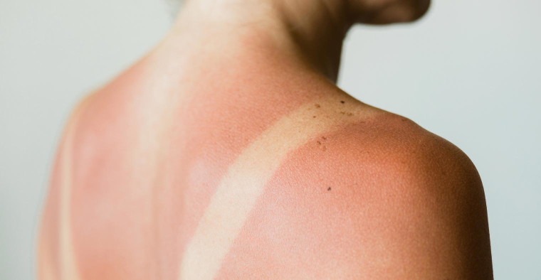 Sunburned shoulders.