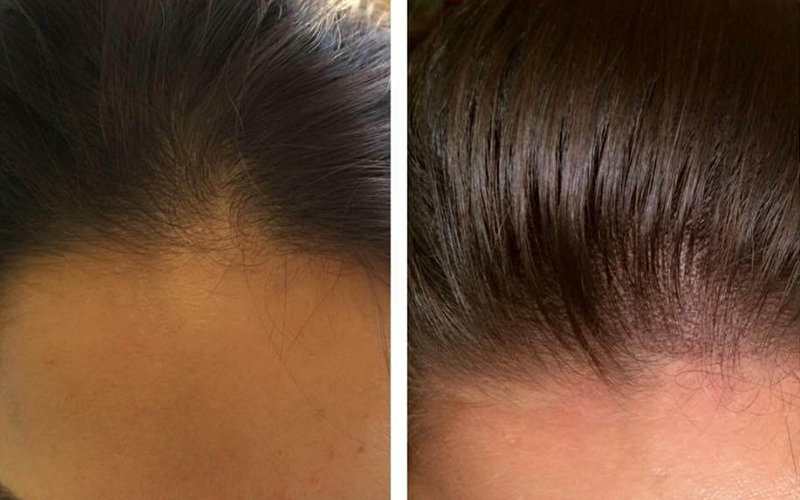 The Treatment for Women Hair Loss The Treatment for Women Hair Loss