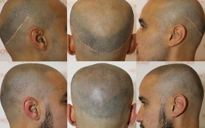 SMP Treatment for Scar Concealment SMP Treatment for Scar Concealment
