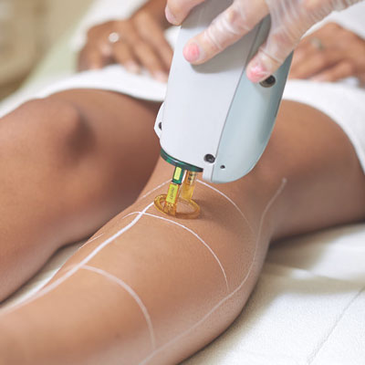 Laser Hair Removal Service