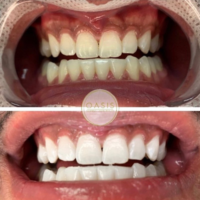 Teeth Whitening Treatment Before and After