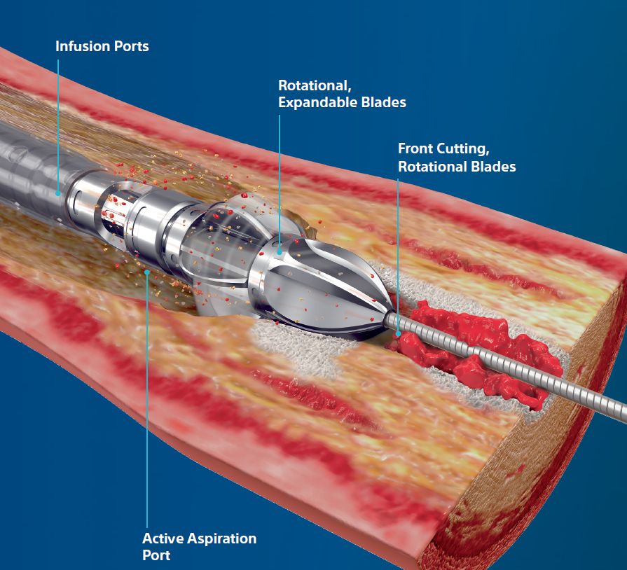 Jetstream™ Atherectomy System – Vascupedia