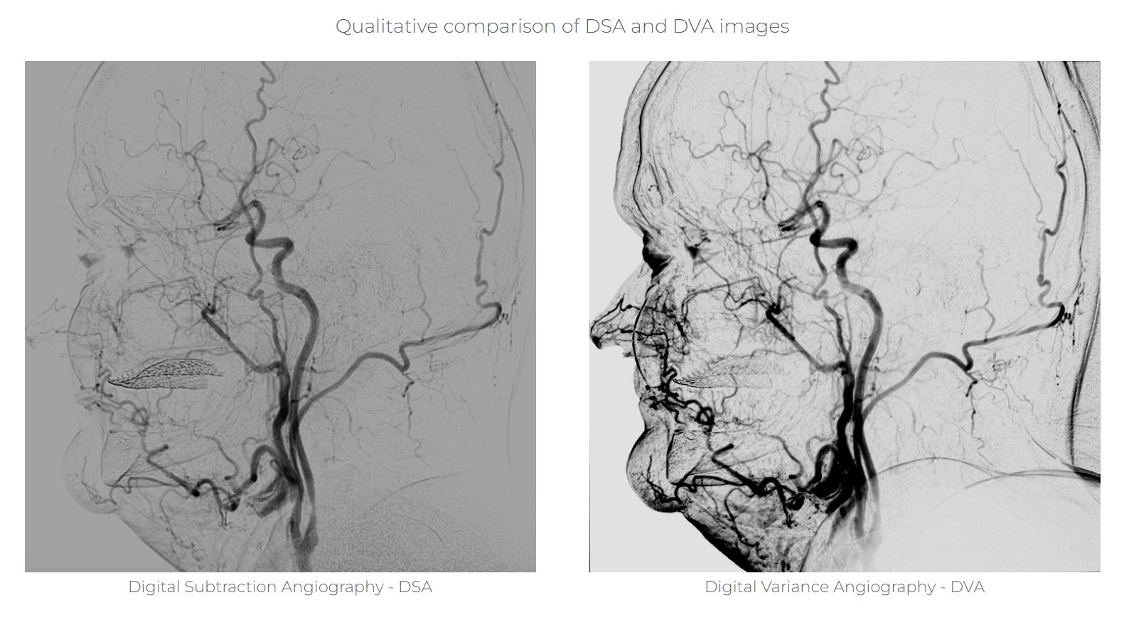 Carotid angiogram lateral view