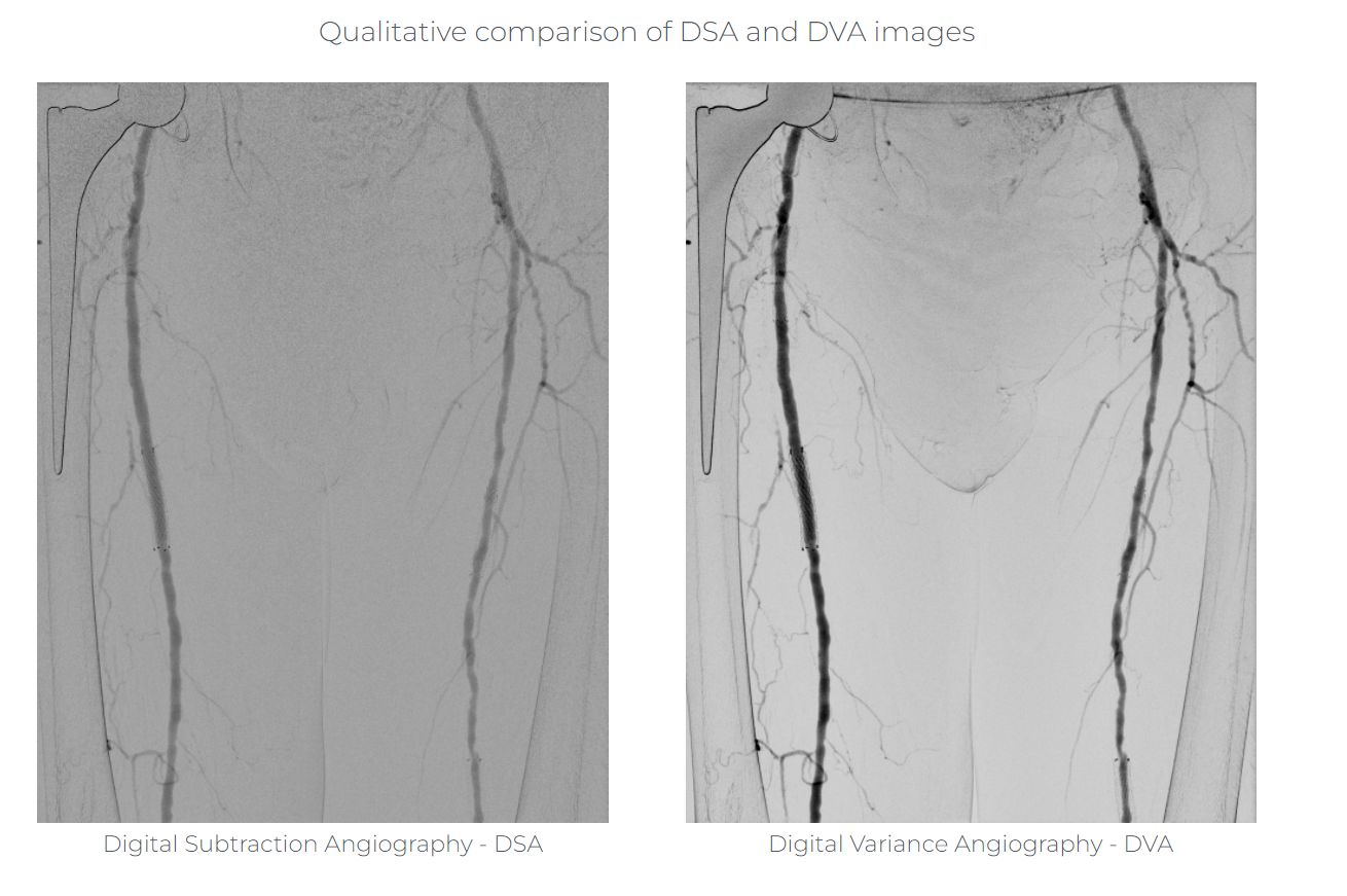 femoral angiogram