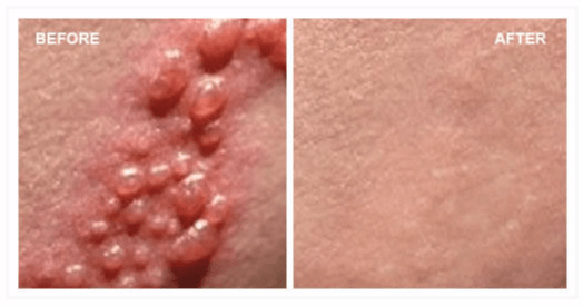 Herpes before and after