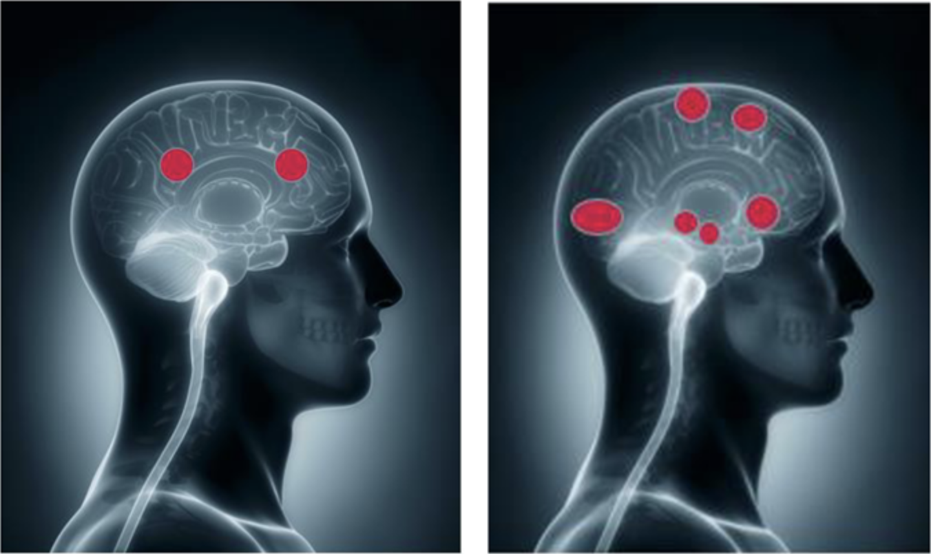 Brain stimulation by facts & information (left) - and when emotions are triggered (right).