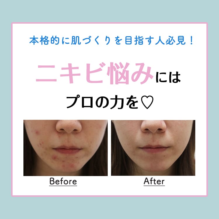 もうニキビに悩まされたくない 美肌づくりには結局プロの力を借りるのが一番の近道 Vivi もうニキビに悩まされたくない 美肌づくりには結局プロの力を借りるのが一番の近道 Vivi