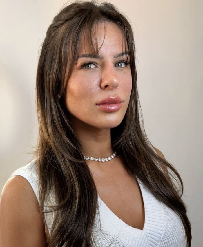 Resultado Barbie Face en Steticolombiana, clínica estética en Las Condes