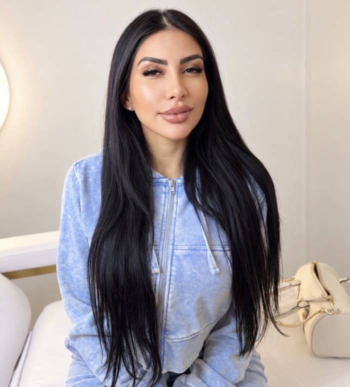 Resultado Barbie Face en Steticolombiana, clínica estética en Las Condes
