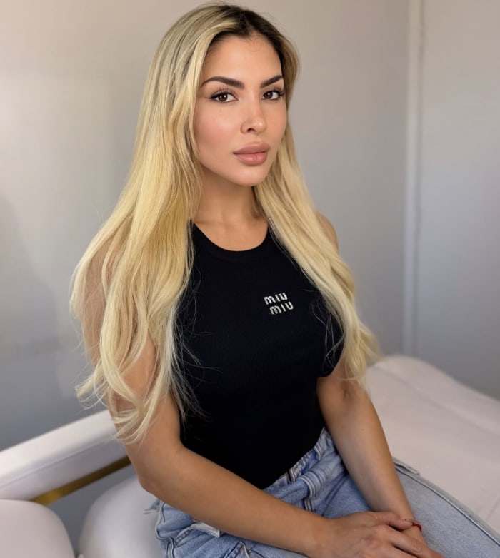 Resultado Full Face en Steticolombiana, clínica estética en Las Condes