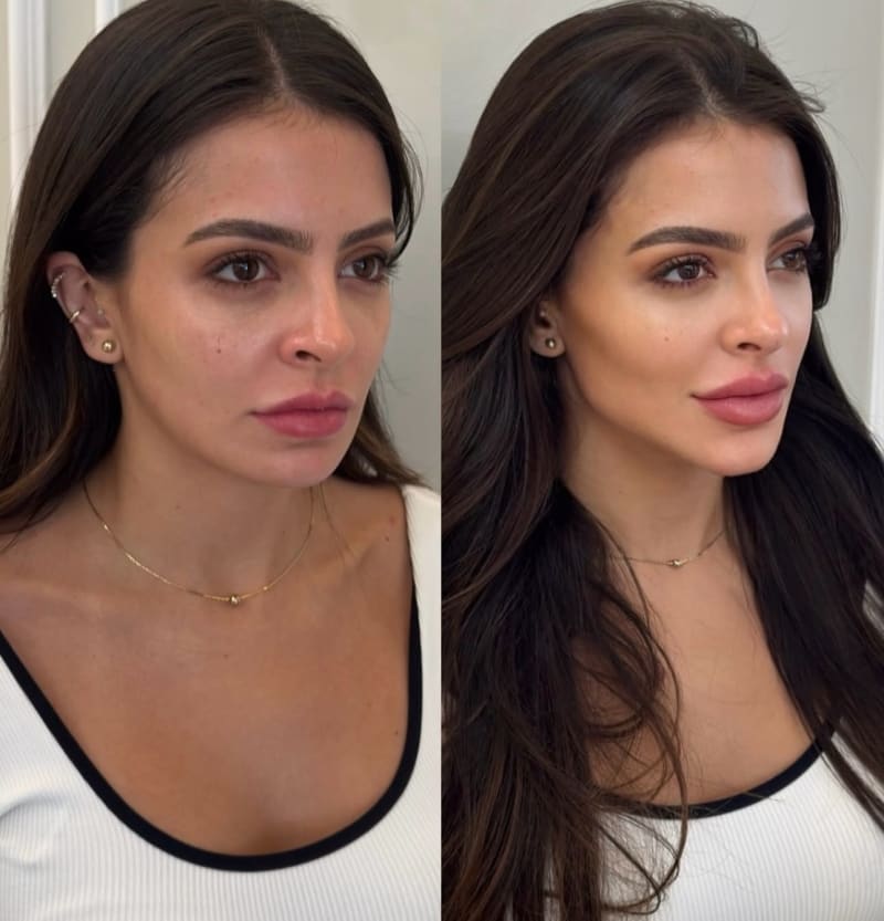 Full Face en Steticolombiana, estética colombiana en Las Condes
