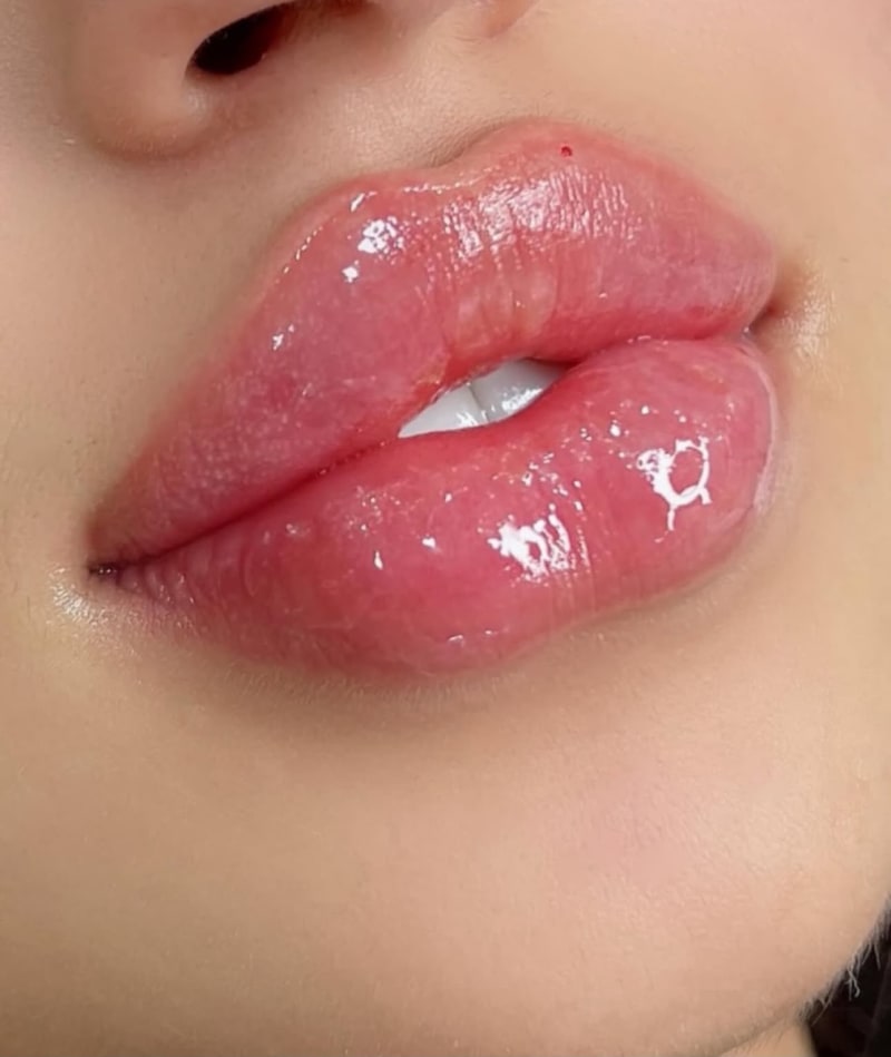 Labios Rusos en Steticolombiana, estética colombiana en Las Condes
