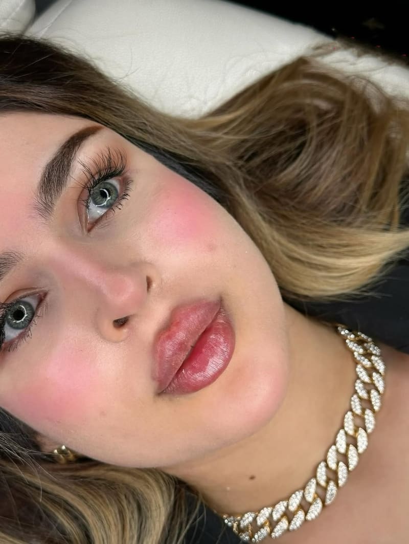 Labios Rusos en Steticolombiana, estética colombiana en Las Condes