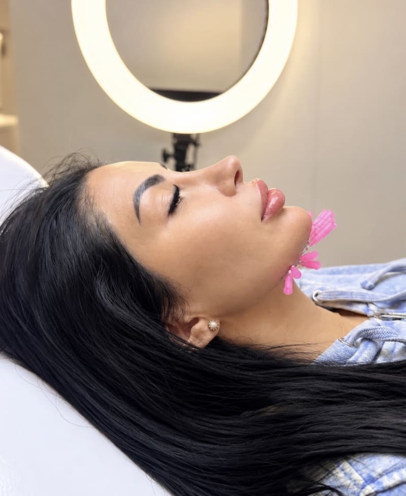Hilos de Colágeno PDO en Steticolombiana, estética colombiana en Las Condes