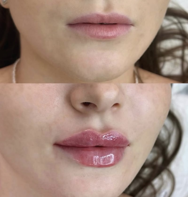 Labios Tradicionales en Steticolombiana, estética colombiana en Las Condes