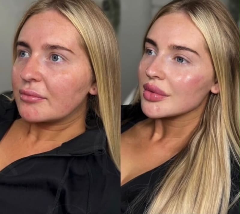 Barbie Face en Steticolombiana, estética colombiana en Las Condes