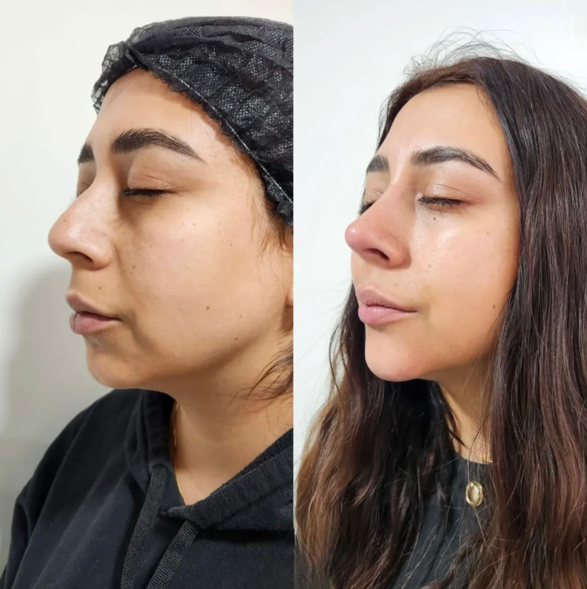 Antes y después de tratamiento en Tempus Clinic