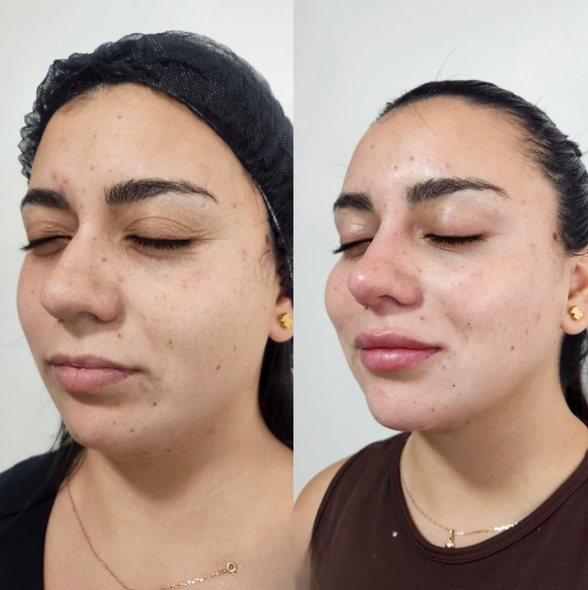 Antes y después de tratamiento en Tempus Clinic