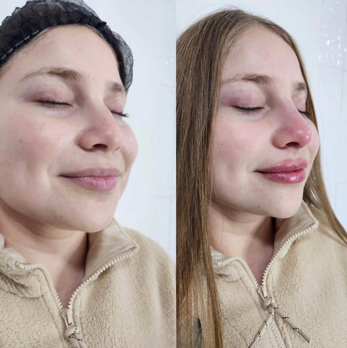 Antes y después de tratamiento en Tempus Clinic