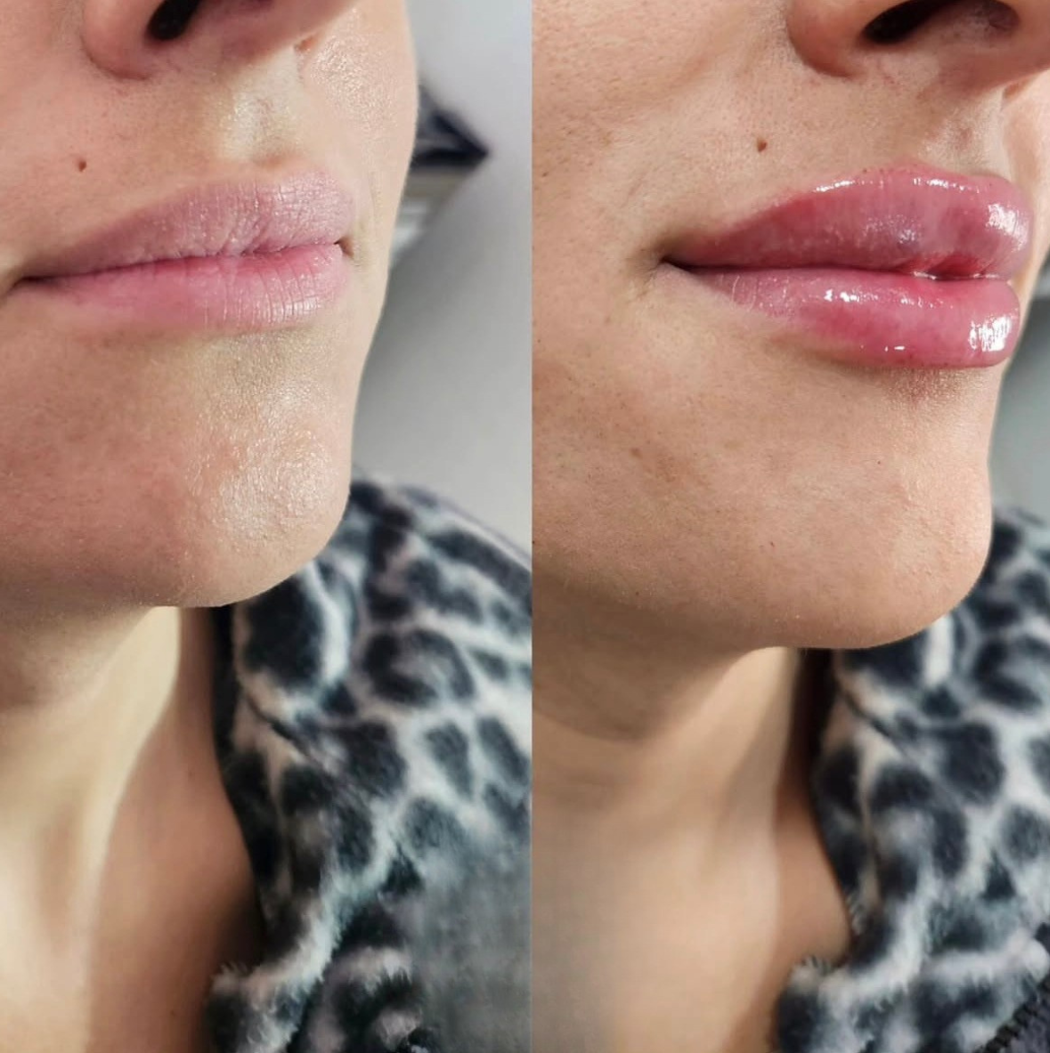 Antes y después de tratamiento en Tempus Clinic
