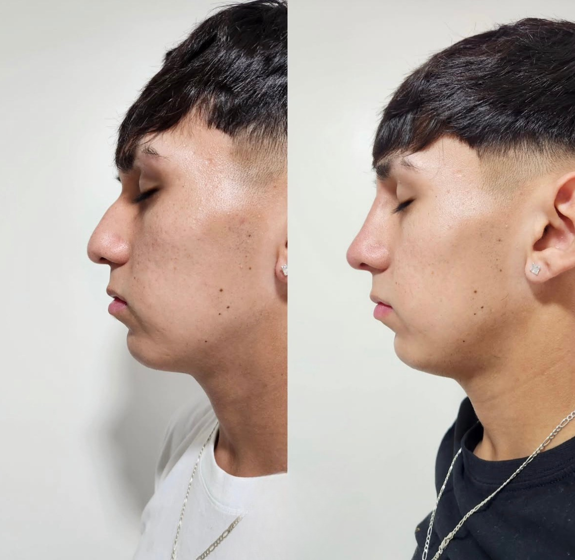 Antes y después de ácido hialurónico en San Felipe - Tempus Clinic