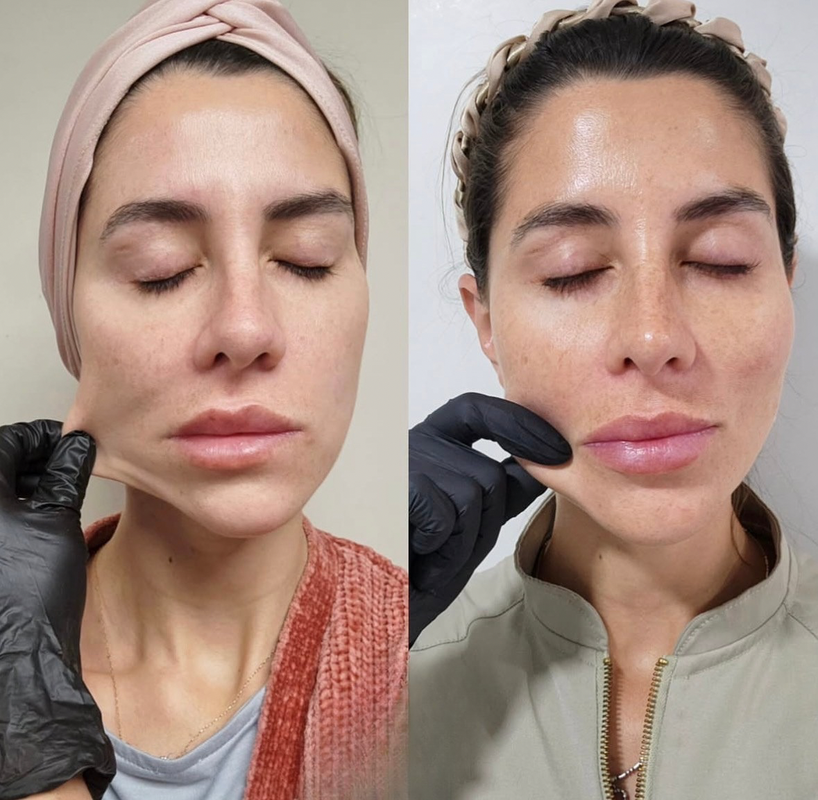 Antes y después de bioestimulación en San Felipe - Tempus Clinic