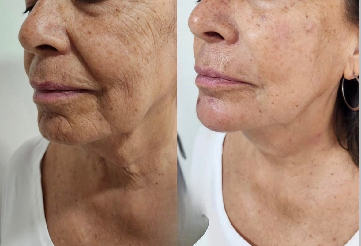 Antes y después de bioestimulación en San Felipe - Tempus Clinic