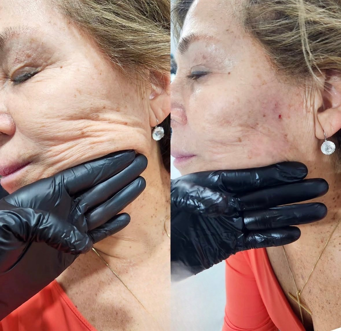 Antes y después de bioestimulación en San Felipe - Tempus Clinic