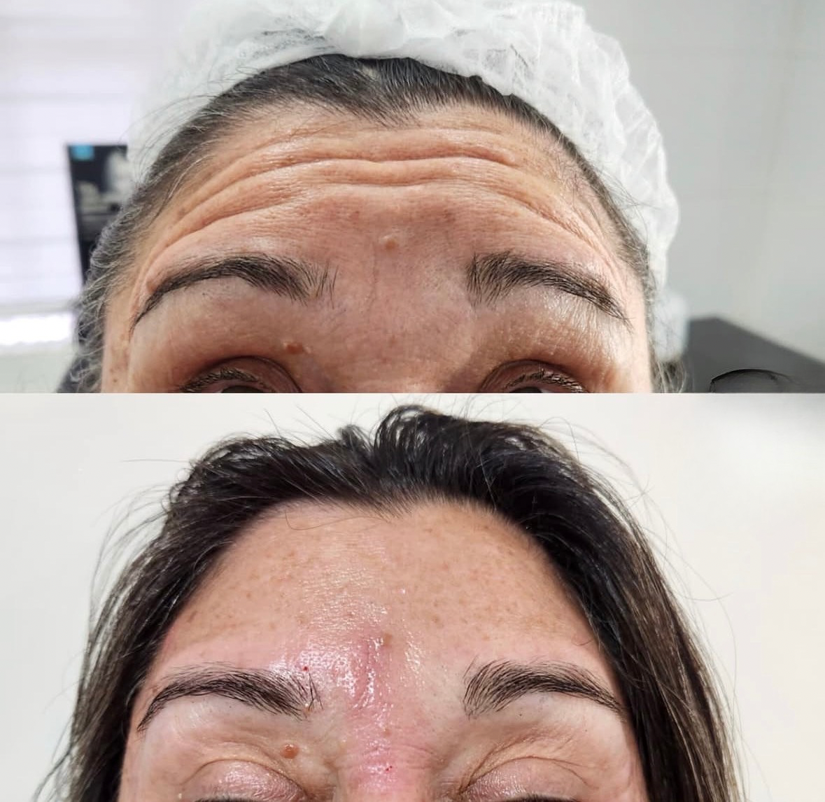 Antes y después de botox en San Felipe - Tempus Clinic