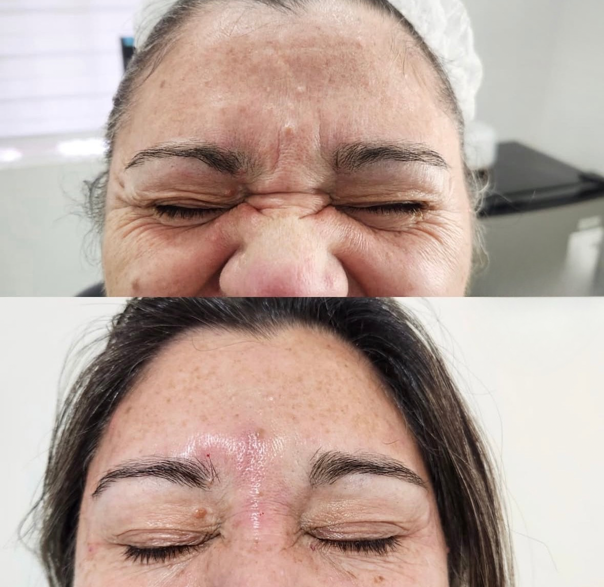Antes y después de botox en San Felipe - Tempus Clinic