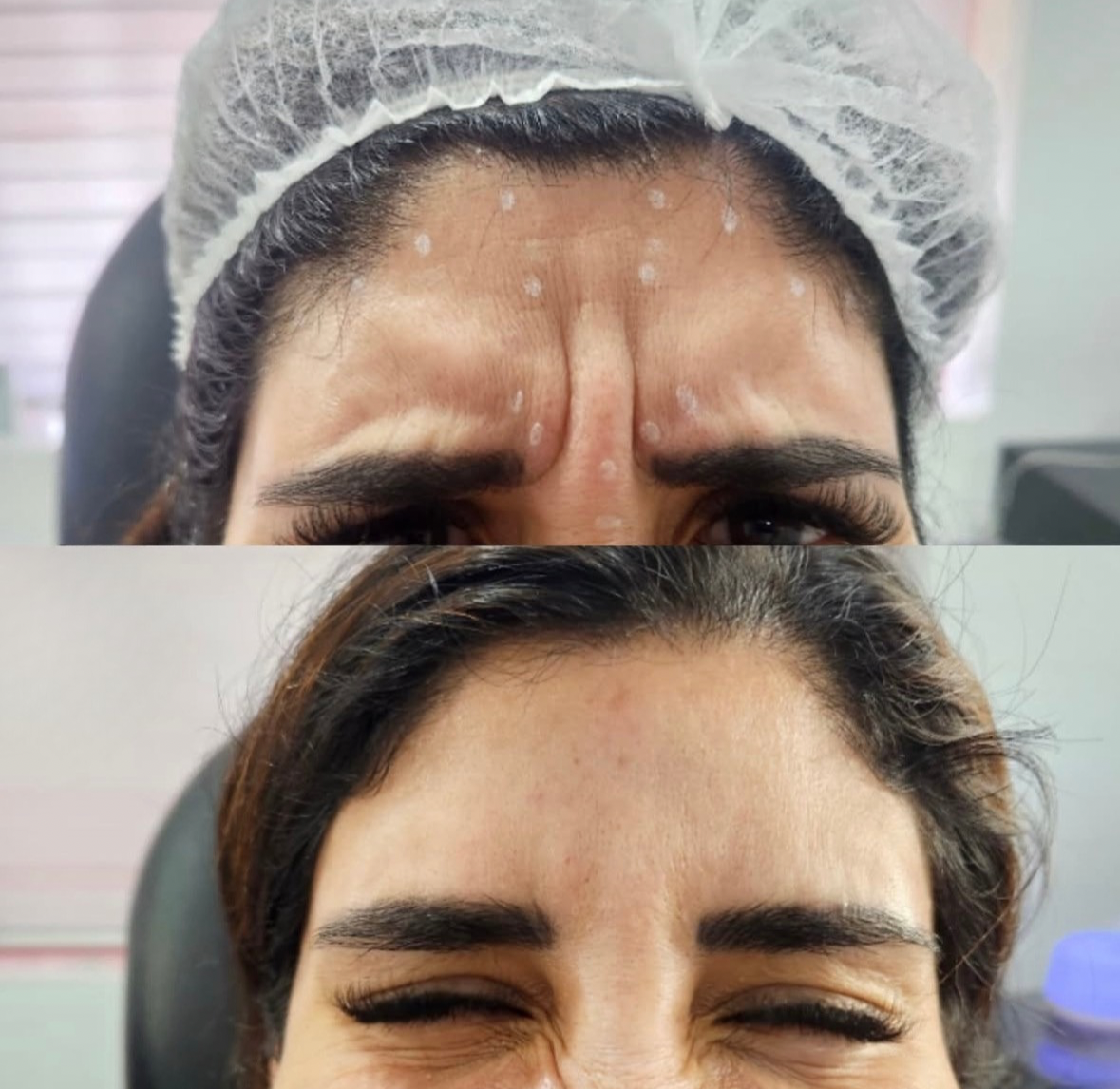 Antes y después de botox en San Felipe - Tempus Clinic