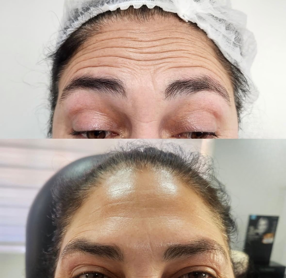 Antes y después de botox en San Felipe - Tempus Clinic
