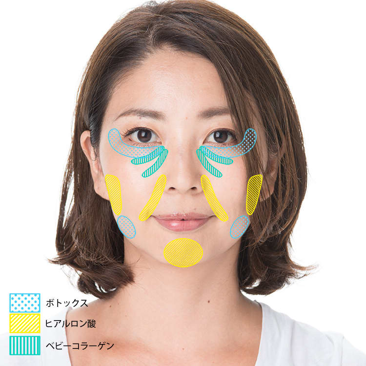 ボトックスとヒアルロン酸で 結果 小顔に見える 40代 見た目年齢 マイナス10歳は叶うのか 崖っぷち美容部 特別編 ビューティニュース 美容メディアvoce ヴォーチェ ボトックスとヒアルロン酸で 結果 小顔に見える 40代 見た目年齢 マイナス10歳は叶うのか 崖っぷち美容部 特別編 ビューティニュース 美容メディアvoce ヴォーチェ