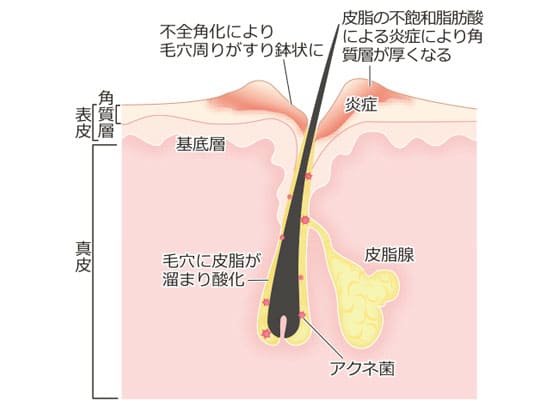 テカりがちで毛穴が開きやすい肌グセ 皮脂ただれの超詳細予防と対策 ビューティニュース 美容メディアvoce ヴォーチェ テカりがちで毛穴が開きやすい肌グセ 皮脂ただれの超詳細予防と対策 ビューティニュース 美容メディアvoce ヴォーチェ