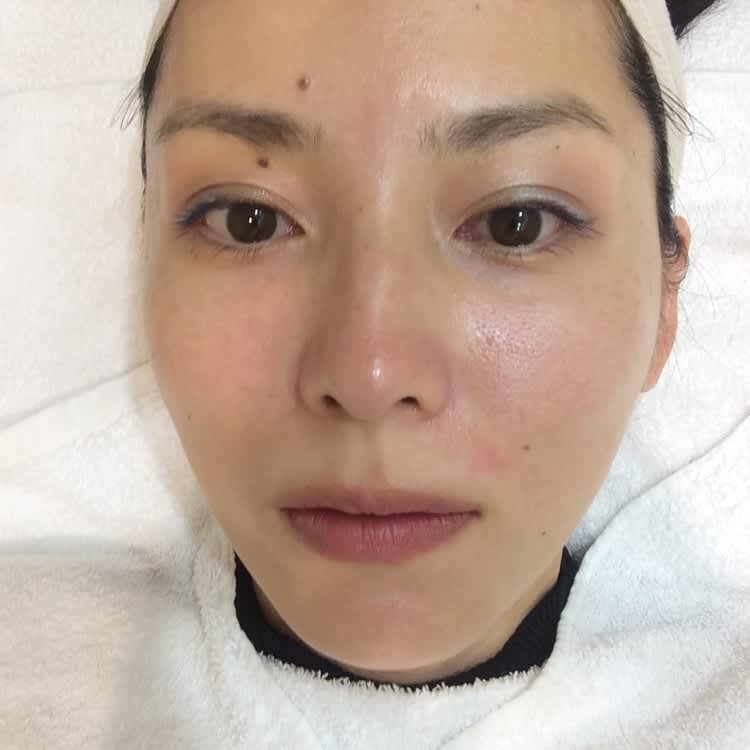 毛穴ケア専門サロン ウビクエ 初体験 長年溜まった毛穴の汚れとさようなら ビューティニュース 美容メディアvoce ヴォーチェ