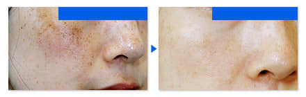 ビューティニュース クリニックに駆け込む前に 自宅でできるシミ 色ムラケアとは 美容メディアvoce ヴォーチェ