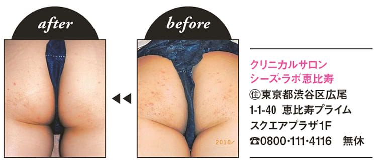 歯の黄ばみ もじゃもじゃ背な毛 ブツブツお尻 駆け込みレスキュー ビューティニュース 美容メディアvoce ヴォーチェ 歯の黄ばみ もじゃもじゃ背な毛 ブツブツお尻 駆け込みレスキュー ビューティニュース 美容メディアvoce ヴォーチェ