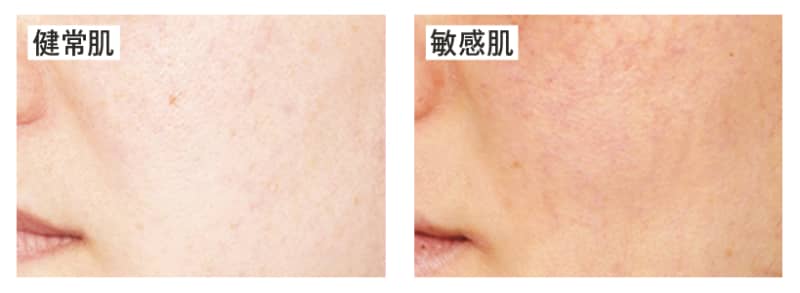 敏感肌は老けやすい 大人の敏感肌の超基本 ビューティニュース 美容メディアvoce ヴォーチェ 敏感肌は老けやすい 大人の敏感肌の超基本 ビューティニュース 美容メディアvoce ヴォーチェ