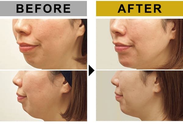 BEFORE/AFTER