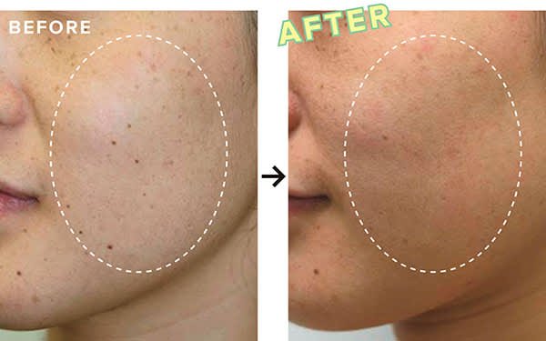 BEFORE ・AFTER/フォトフェイシャル+イオン導入+プラセンタパック
