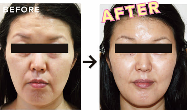 BEFORE・AFTER/ダブロゴールド