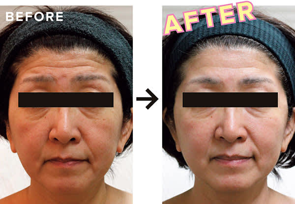 BEFORE・AFTER/スレッドリフト